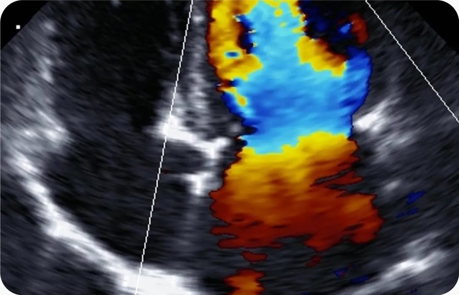 Imagem de doppler colorido em equipamento de ultrassom